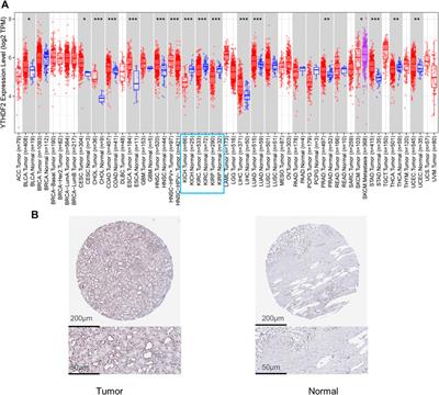 YTHDF2 is a Potential Biomarker and Associated with Immune Infiltration in Kidney Renal Clear Cell Carcinoma